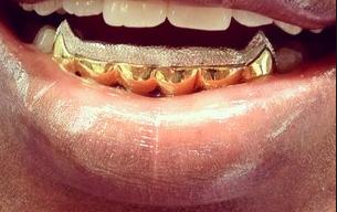 Custom Made 14k Gold Overlay Removable Grillz Teeth /Gold Plate Caps/ 6 Teeth Top or Bottom Fangs/4