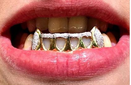 Custom Made 14k Gold Overlay Removable Grillz Teeth /Gold Plate Caps/ 6 Teeth Top or Bottom Fangs/9