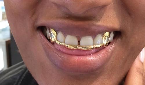 Custom Made 14k Gold Overlay Removable Grillz Teeth /Gold Plate Caps/ 6 Teeth Top or Bottom Fangs/11