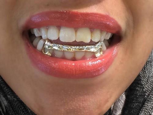 Custom Made 14k Gold Overlay Removable Grillz Teeth /Gold Plate Caps/ 6 Teeth Top or Bottom Fangs/12
